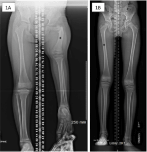 femur anatomy xray