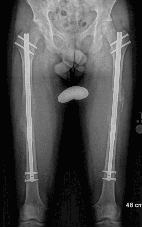 Key Techniques: Bone lengthening with an Internal